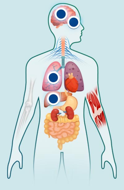 toxocariosis