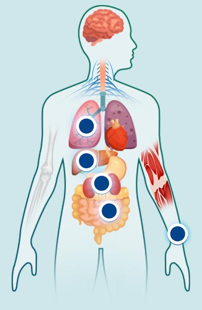 rickettsiosis