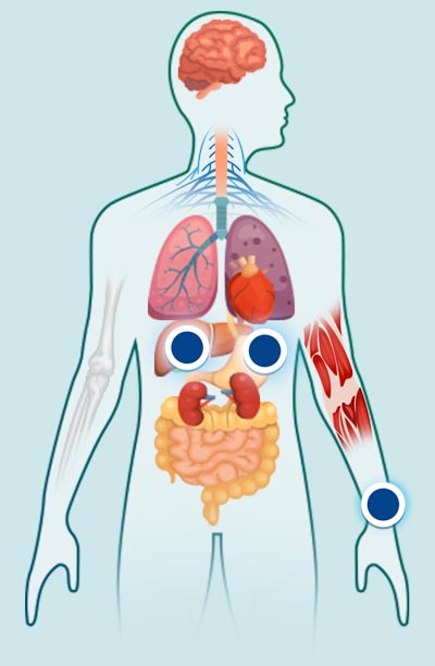 leishmaniosis